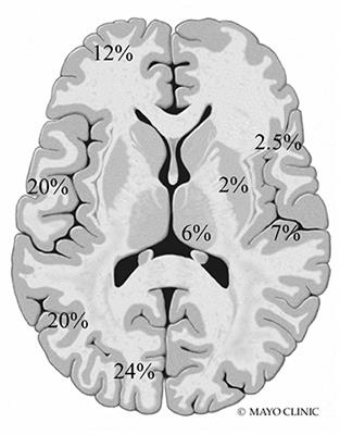 Seizure Semiology, EEG, and Imaging Findings in Epilepsy Secondary to Mitochondrial Disease